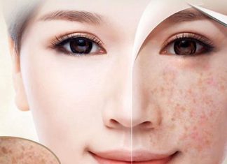 4 bước cơ bản hạn chế thâm nám, đồi mồi da