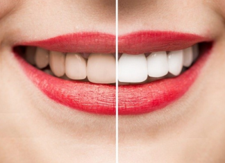 Cảnh báo nguy cơ hoại tử nướu do dùng miếng dán tẩy trắng răng